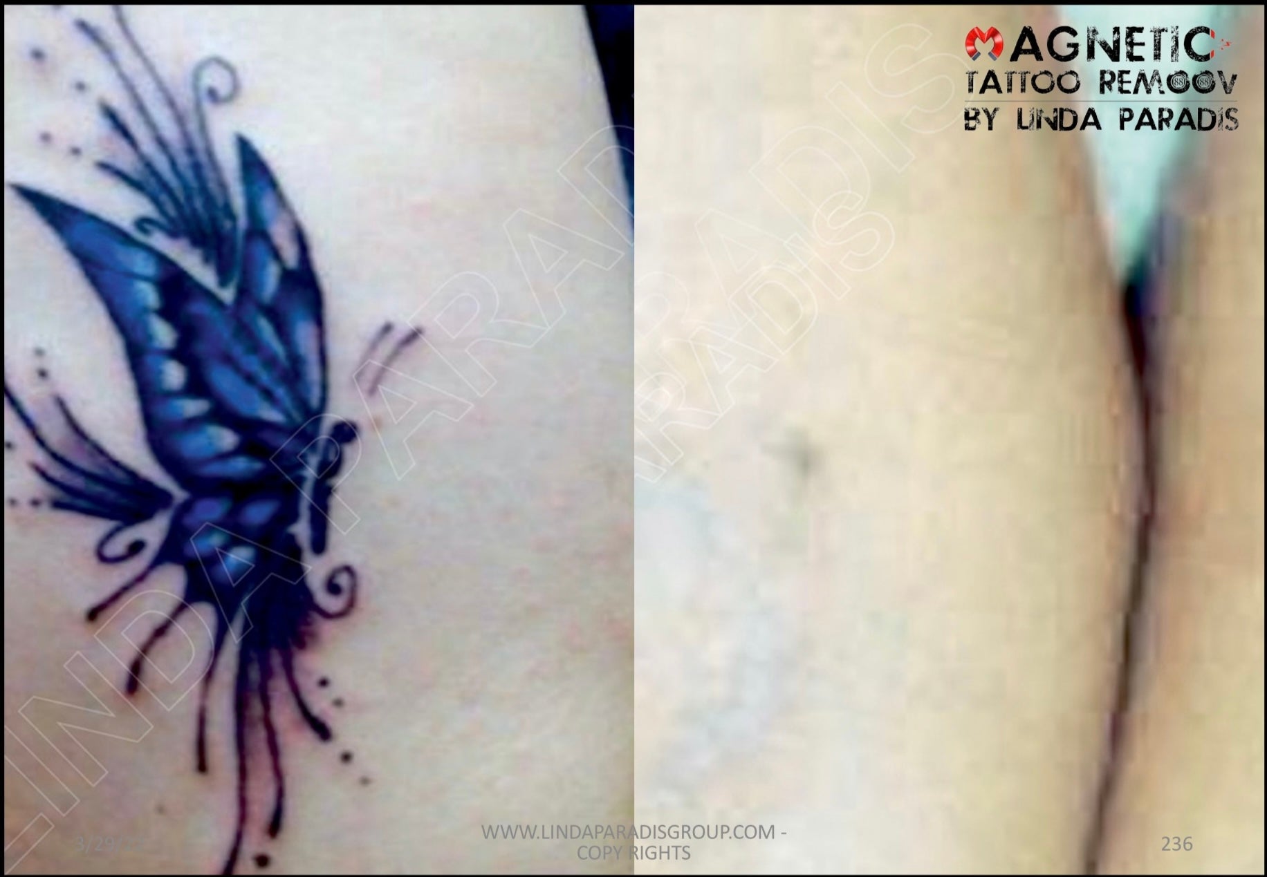 Tattoo Removal  SkinVolution  GLENDALE AZ
